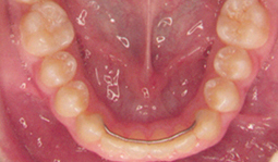 Ein Sechs-Punkt-Retainer stabilisiert die Zähne nach umfangreichen Zahnbewegungen.