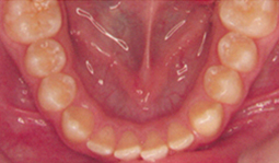 Dreh- und Engstände benötigen eine Langzeit Retention.  
